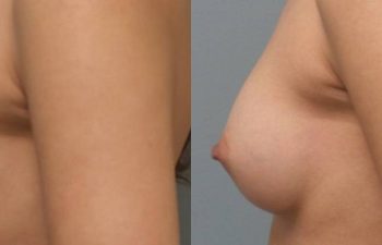 Female Patient Before & After Breast Augmentation