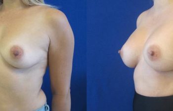 Female Patient Before & After Breast Augmentation