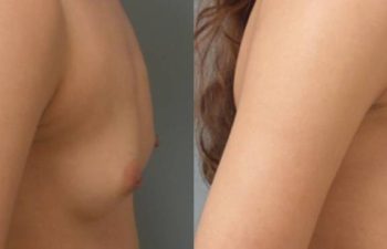 Female Patient Before & After Breast Augmentation