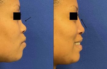 Female Patient Before & After Non Surgical Rhinoplasty