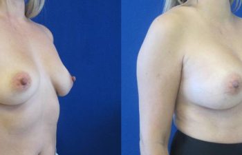 Female Patient Before & After Breast Augmentation