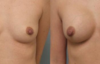Female Patient Before & After Breast Augmentation