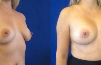 Female Patient Before & After Breast Augmentation