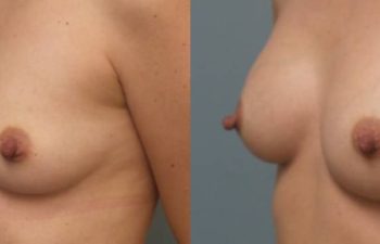 Female Patient Before & After Breast Augmentation