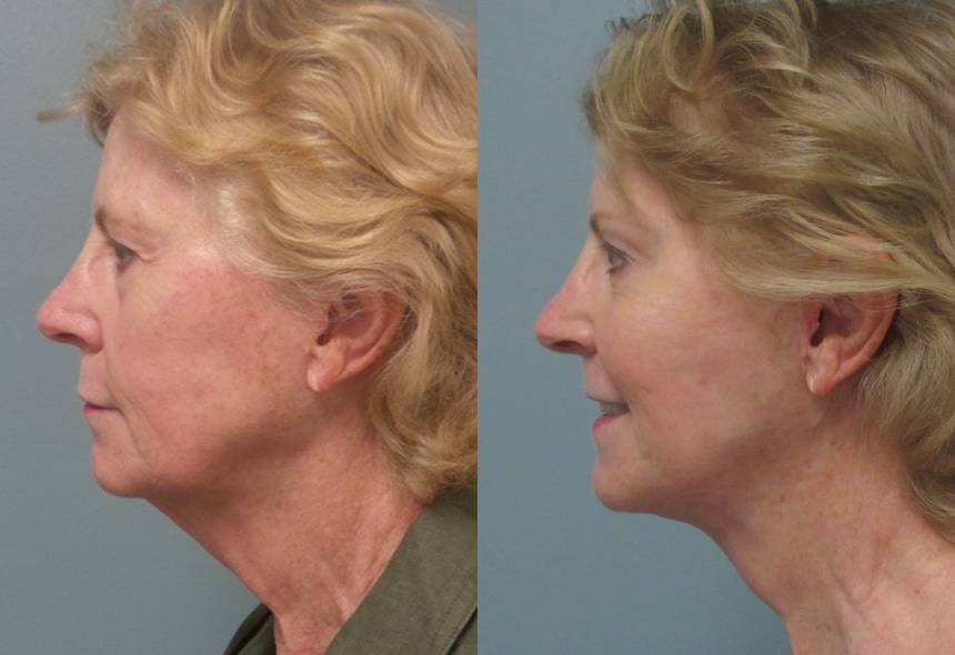 Female Patient Before & After FaceLift