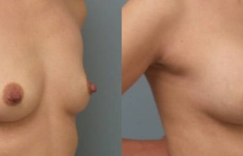 Female Patient Before & After Breast Augmentation