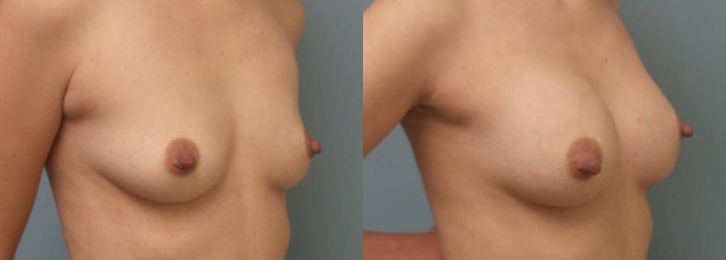 Female Patient Before & After Breast Augmentation