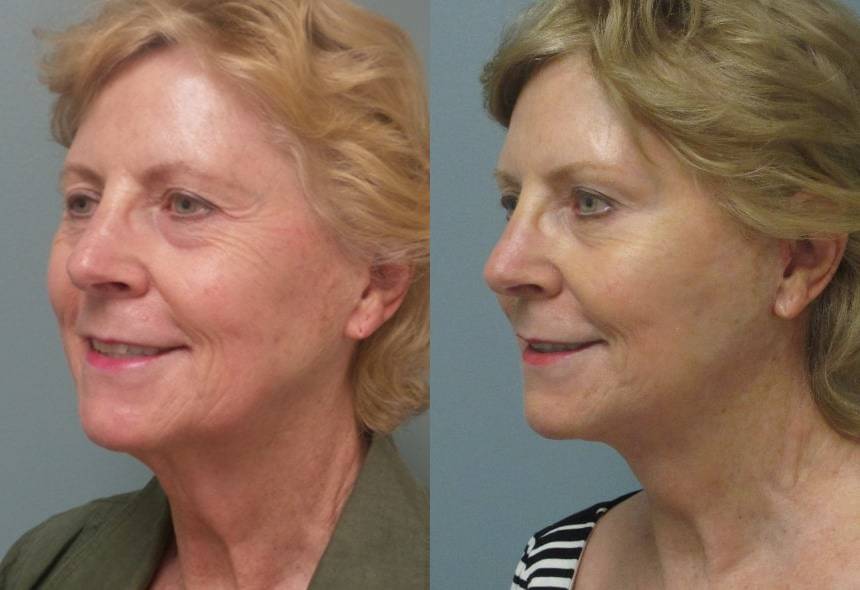 Female Patient Before & After FaceLift