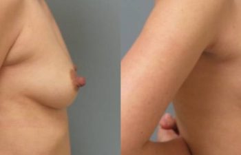 Female Patient Before & After Breast Augmentation