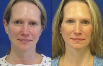 Female Patient Before & After Mini FaceLift