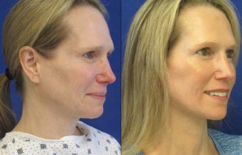 Female Patient Before & After Mini FaceLift