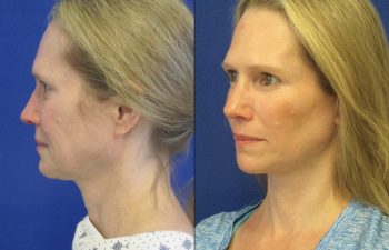 Female Patient Before & After Mini FaceLift