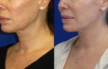 Female Patient Before & After Mini FaceLift