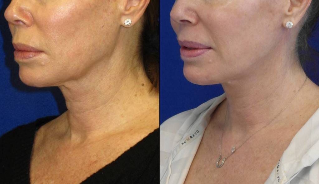 Female Patient Before & After Mini FaceLift