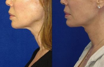 Female Patient Before & After Mini FaceLift