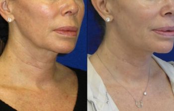 Female Patient Before & After Mini FaceLift