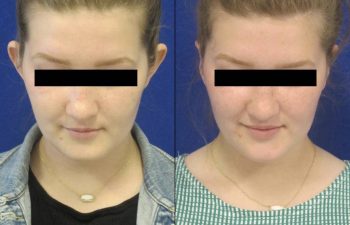 Female Patient Before & After Otoplasty - Earwell