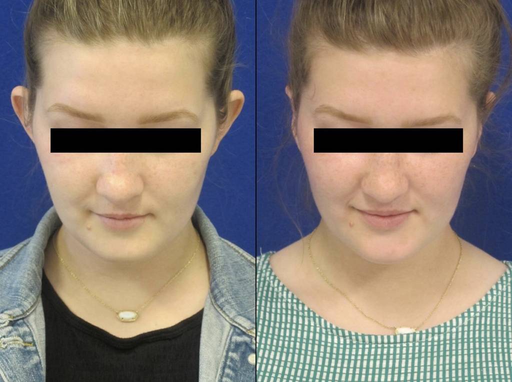 Female Patient Before & After Otoplasty - Earwell