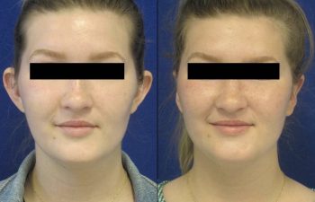 Female Patient Before & After Otoplasty - Earwell