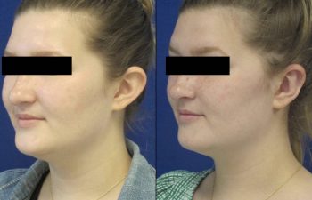 Female Patient Before & After Otoplasty - Earwell