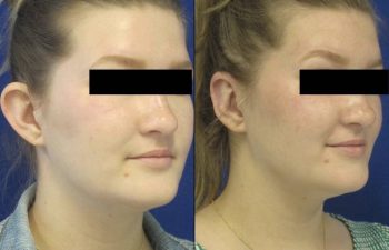 Female Patient Before & After Otoplasty - Earwell