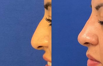 Female Patient Before & After Non Surgical Rhinoplasty
