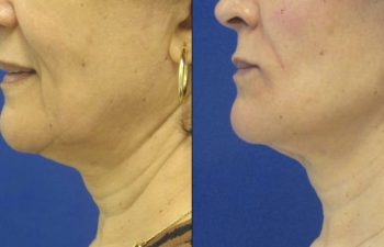 Female Patient Before & After Filler