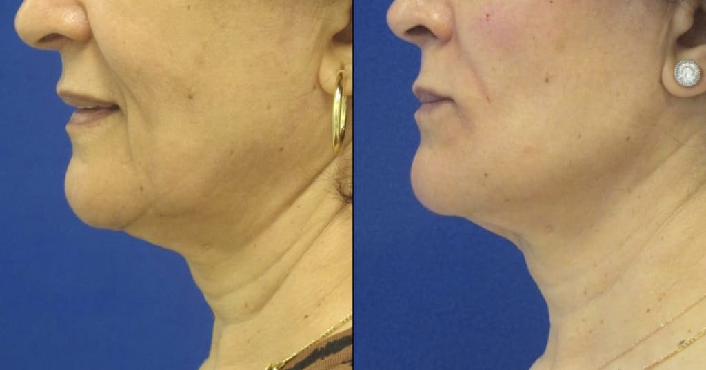 Female Patient Before & After Filler