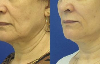 Female Patient Before & After Filler