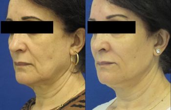 Female Patient Before & After Filler