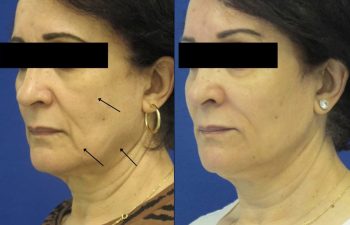 Female Patient Before & After Filler