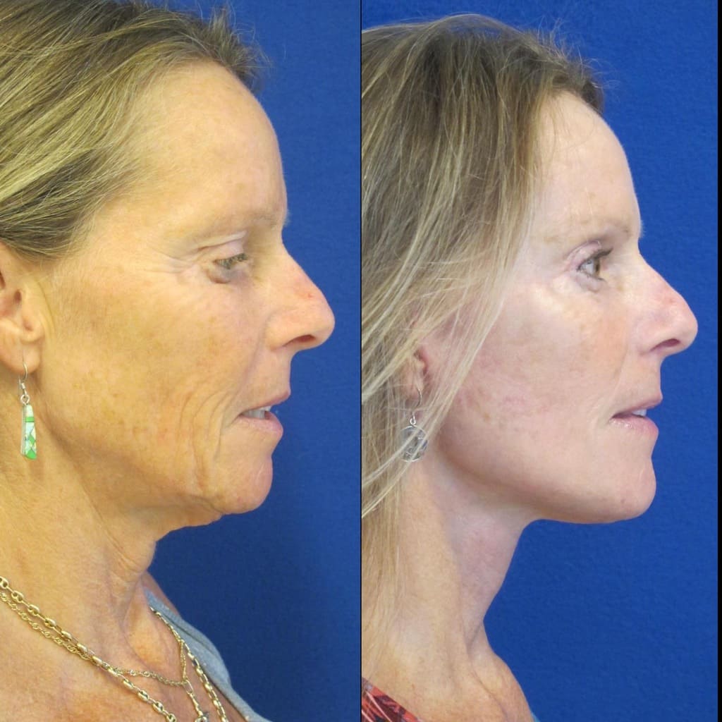 Female Patient Before & After FaceLift