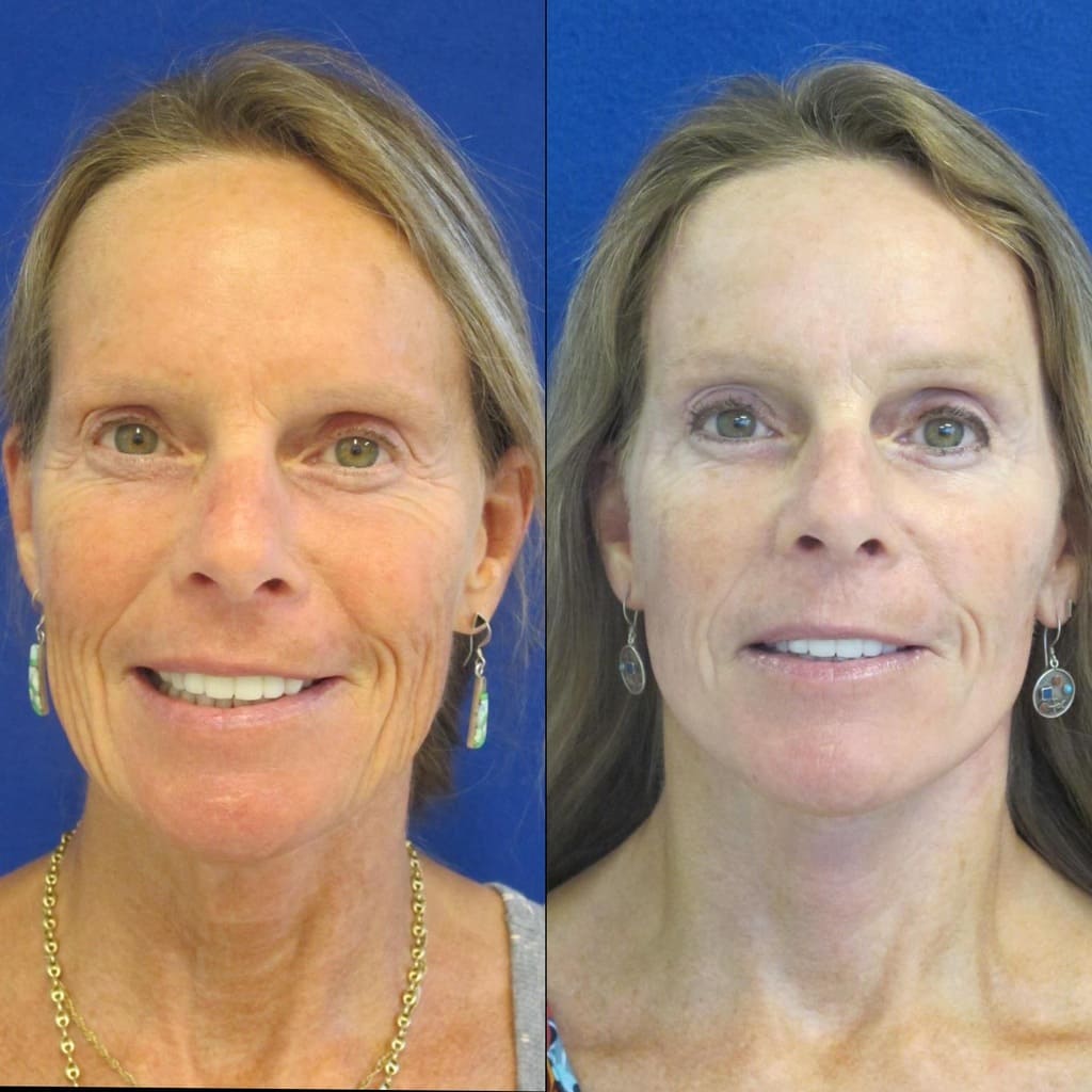 Female Patient Before & After FaceLift