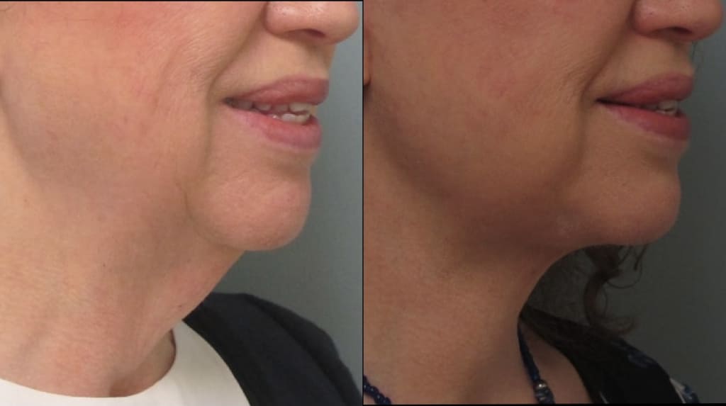 Female Patient Before & After FaceLift