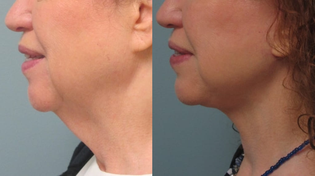 Female Patient Before & After FaceLift