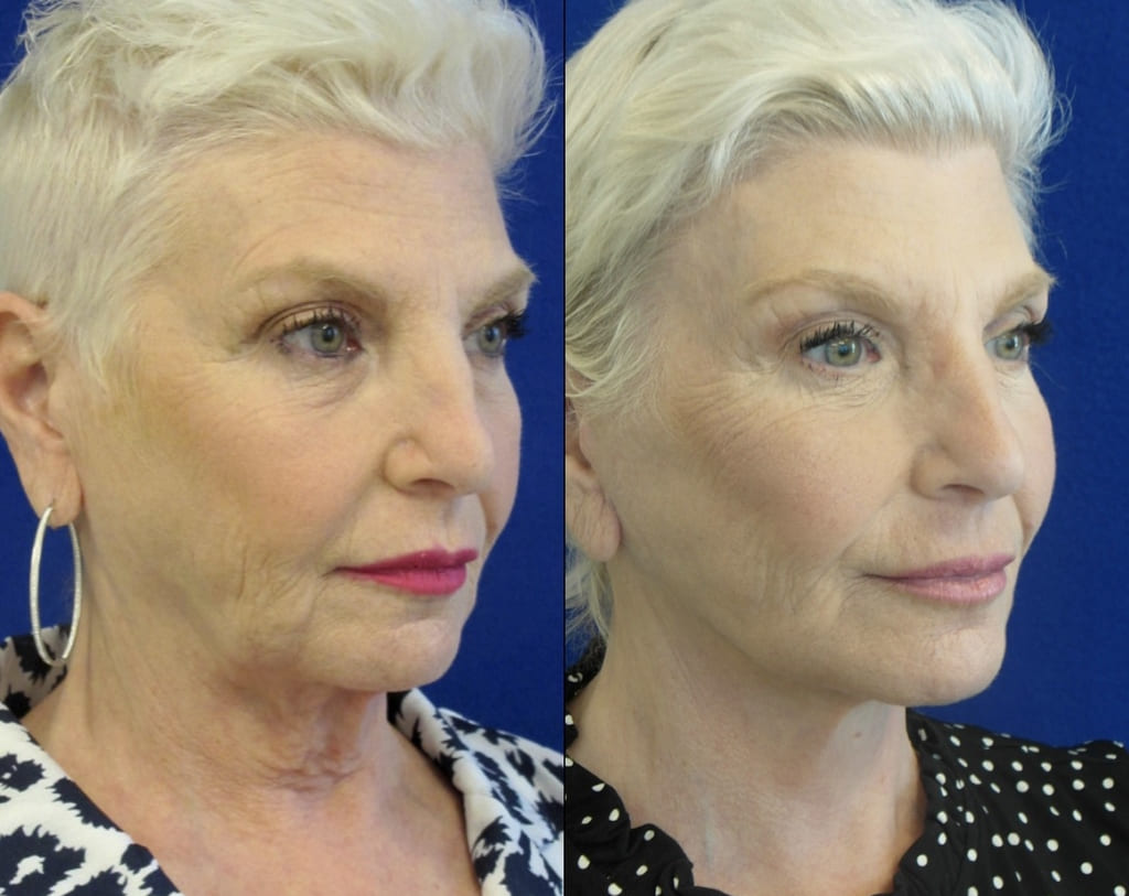 Female Patient Before & After FaceLift
