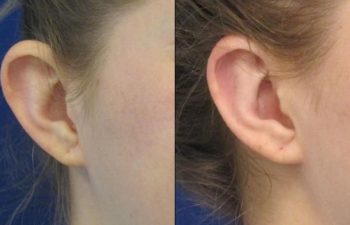 Female Patient Before & After Otoplasty - Earwell