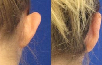 Female Patient Before & After Otoplasty - Earwell
