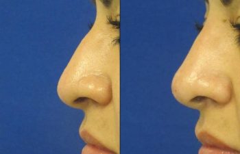 Female Patient Before & After Non Surgical Rhinoplasty