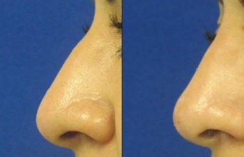 Female Patient Before & After Non Surgical Rhinoplasty