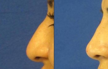 Female Patient Before & After Non Surgical Rhinoplasty