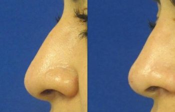 Female Patient Before & After Non Surgical Rhinoplasty