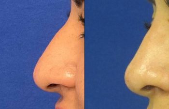 Female Patient Before & After Non Surgical Rhinoplasty