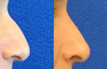 Female Patient Before & After Non Surgical Rhinoplasty