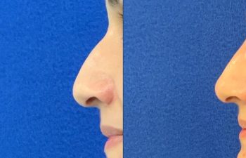 Female Patient Before & After Non Surgical Rhinoplasty