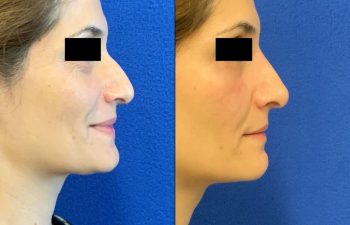 Female Patient Before & After Non Surgical Rhinoplasty