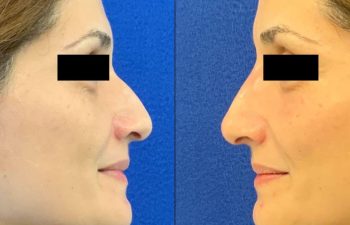 Female Patient Before & After Non Surgical Rhinoplasty