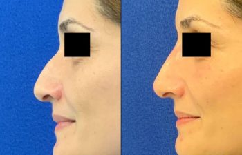 Female Patient Before & After Non Surgical Rhinoplasty