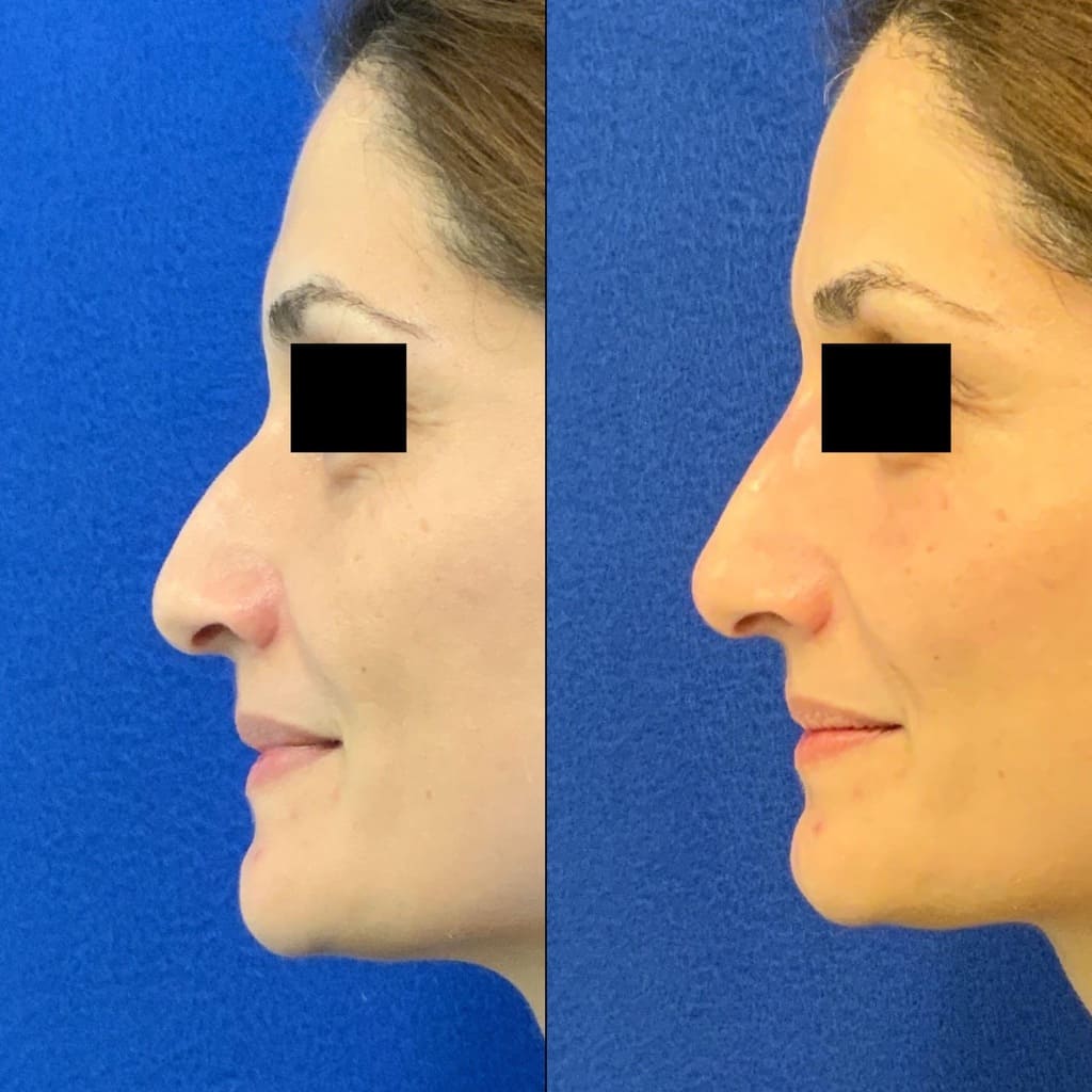 Female Patient Before & After Non Surgical Rhinoplasty
