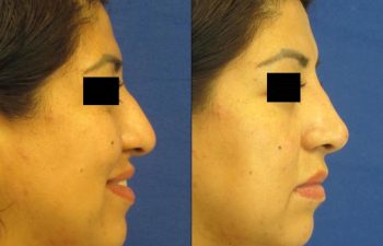 Female Patient Before & After Non Surgical Rhinoplasty
